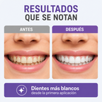Tiras Blanqueadoras Dentales X14u Purple Whitening Strips